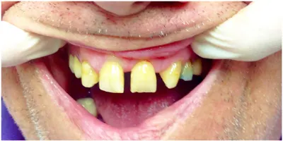 Before photo, first smile gallery case: front view of a patient's teeth before treatment