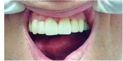 After photo, first smile gallery case: the same patient's brighter, more even smile after treatment