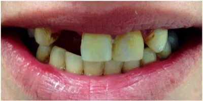 Before photo, smile gallery case 2: front view of a patient's teeth before treatment at Elite Boca Dental