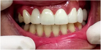 After photo, smile gallery case 2: the same patient's smile after treatment, visibly brighter and more even