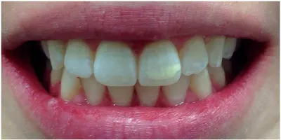 Before photo, smile gallery case 3: front view of a patient's teeth before treatment at Elite Boca Dental