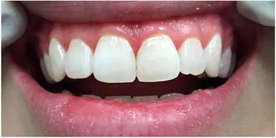 After photo, smile gallery case 3: the same patient's smile after treatment, visibly brighter and more even