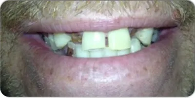 Before photo, smile gallery case 4: front view of a patient's teeth before treatment at Elite Boca Dental