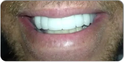 After photo, smile gallery case 4: the same patient's smile after treatment, visibly brighter and more even