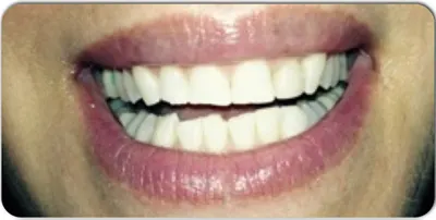 Before photo, smile gallery case 5: front view of a patient's teeth before treatment at Elite Boca Dental