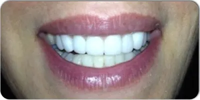 After photo, smile gallery case 5: the same patient's smile after treatment, visibly brighter and more even