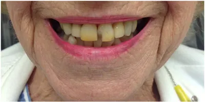 Before photo, smile gallery case 6: front view of a patient's teeth before treatment at Elite Boca Dental