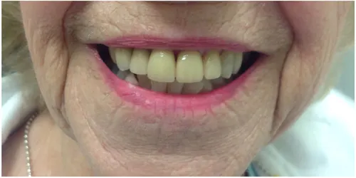After photo, smile gallery case 6: the same patient's smile after treatment, visibly brighter and more even